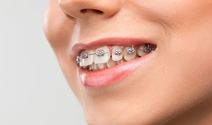 BRACES in mississauga